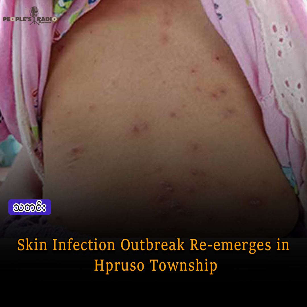 Skin Infection Outbreak Re-emerges in Hpruso Township